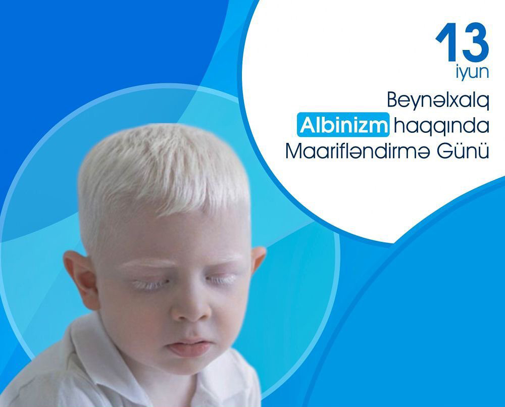  13 iyun - Beynəlxalq Albinizm haqqında Maarifləndirmə Günüdür   