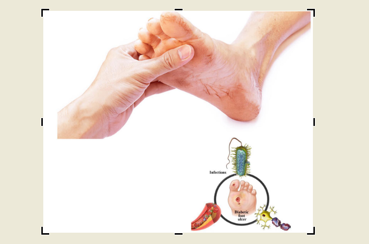 Şəkərli diabet zamanı neyropatiya