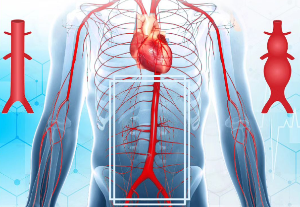 Aortanın anevrizması nədir? Təhlükəli patoloji dəyişikliklərə səbəb olur