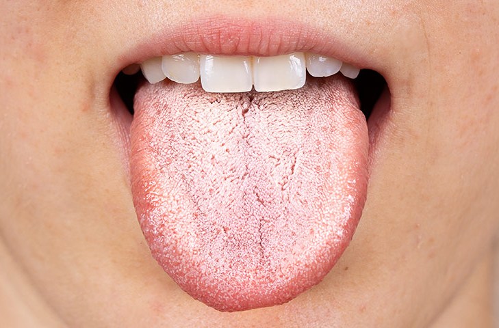 Dildə lövhələr həzm sistemi ilə bağlı ola bilər