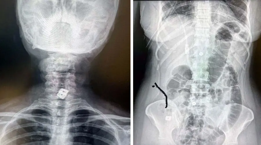 Tibb ədəbiyyatında nadir hal: Boynuna taxılan implant mədəsinə düşdü