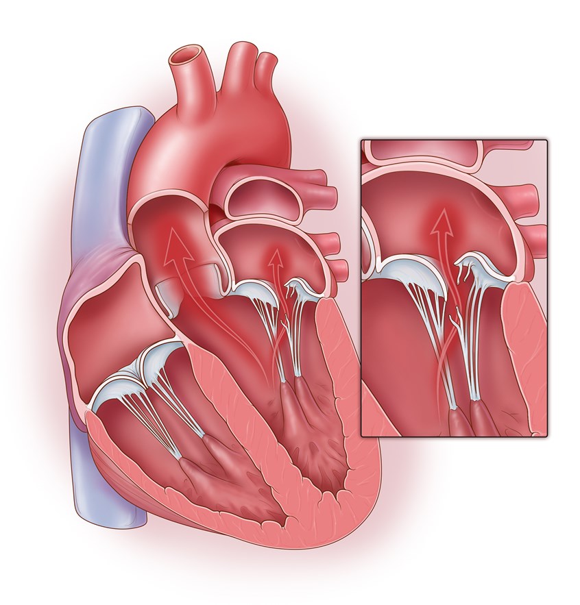  Qapaq təmiri mitral qapaq çatışmazlığı üçün ən ideal müalicə üsuludur   
