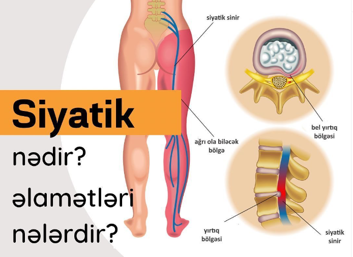 Siyatikin müalicəsi necə aparılır?