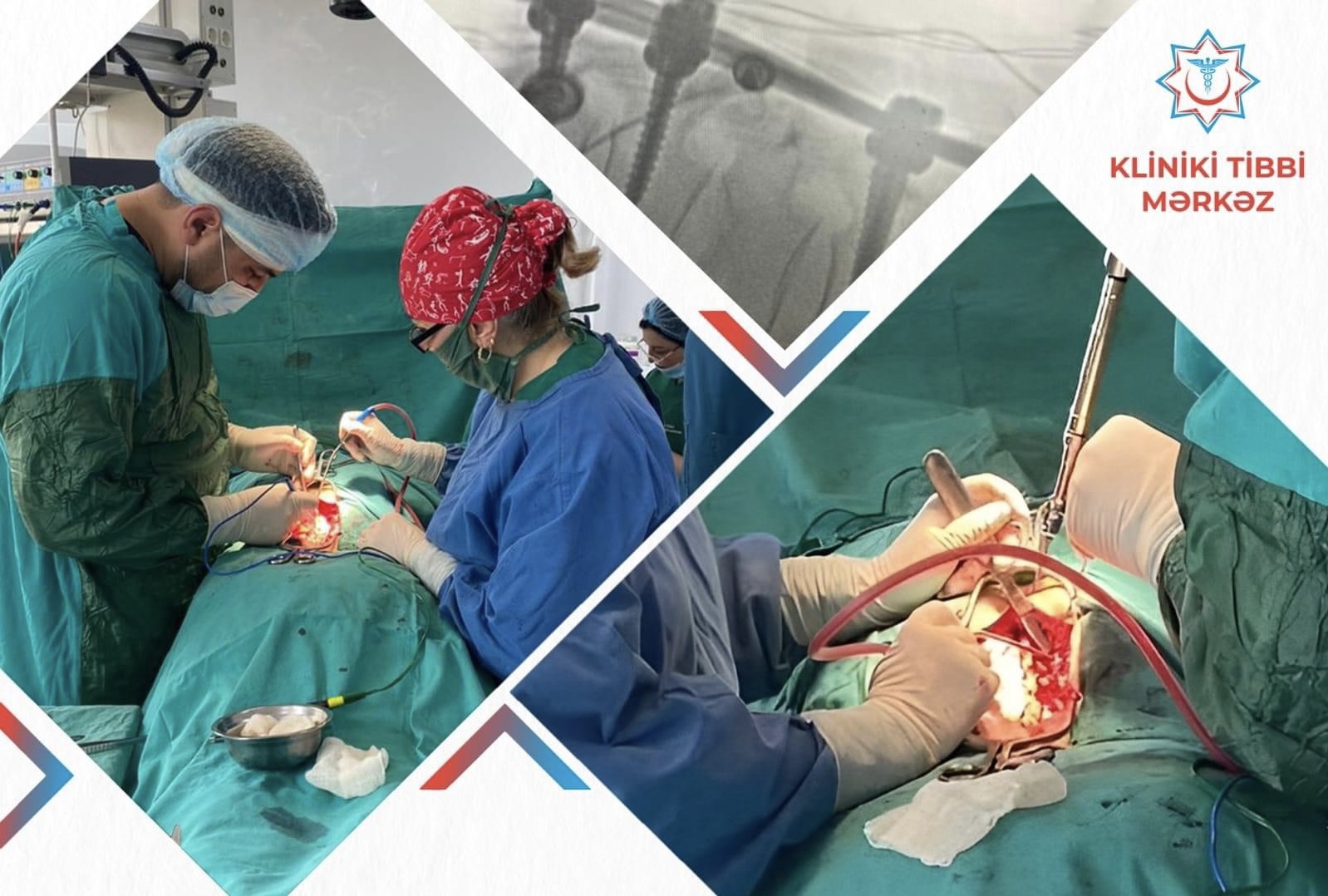 Yıxılaraq bel fəqərəsi sınan 64 yaşlı xəstə KTM-də uğurla əməliyyat olunub