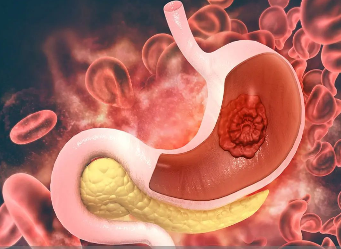 Mədə xərçəngində cərrahi müalicənin üstünlüyü nədir?