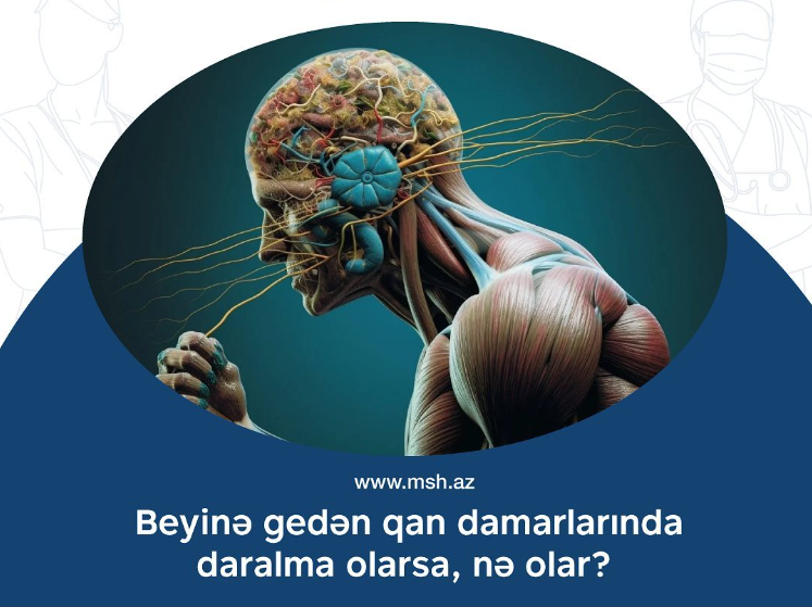 Beynə gedən qan damarlarında daralmanın fəsadları