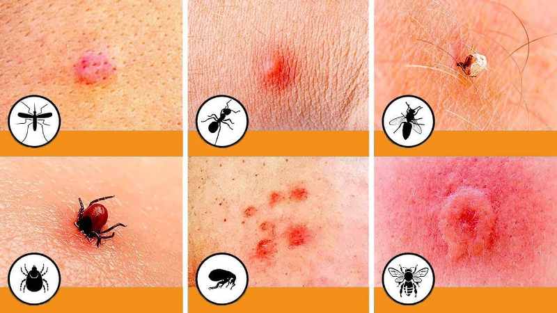 Həşərat dişləməsi zamanı allergik reaksiya necə baş verir? İmmunoloqun izahında