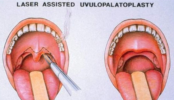 Uvuloplastika nədir? - Bu müalicə üsulu hansı halda təklif edilir?
