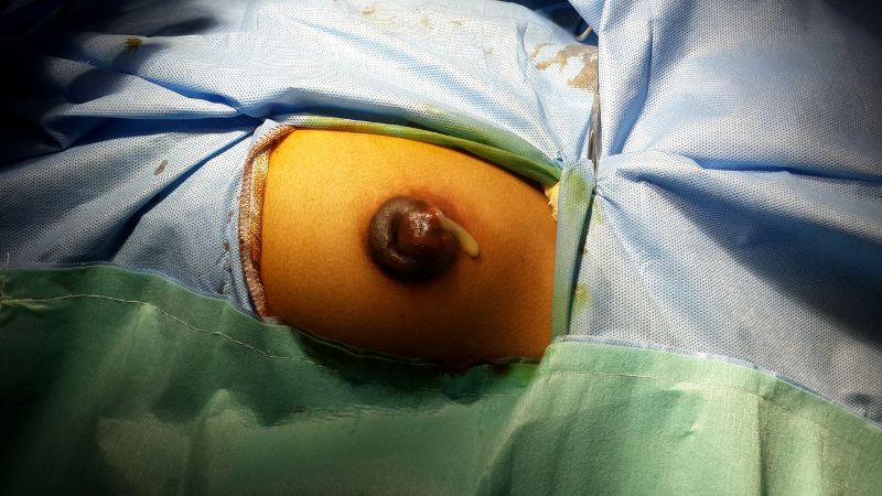 Süd vəzi vərəmi nədir?