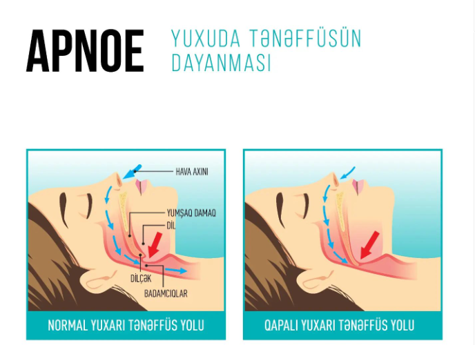 Yuxuda tənəffüsün dayanması – Bu sindroma nə səbəb olur?