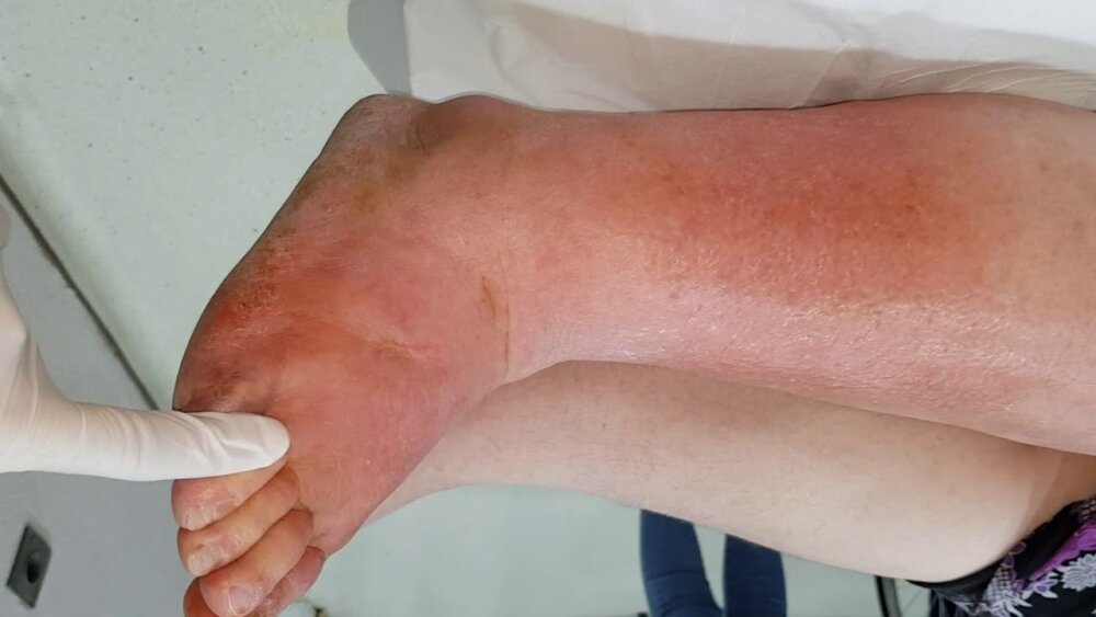 Qızıl yel streptokokk mikrobun törətdiyi ağır infeksion xəstəlikdir