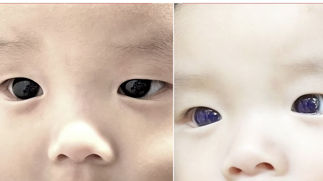 Taylandda koronavirusa qarşı dərman qəbul edən körpənin gözlərinin rəngi dəyişib