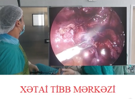 Xətai Tibb Mərkəzində ilk dəfə laparoskopiya əməliyyatı həyata keçirilib