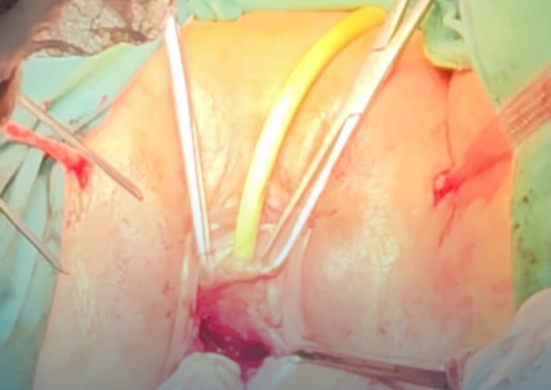  Binəqədi Tibb Mərkəzində növbəti dəfə TOT əməliyyatı icra edilib   