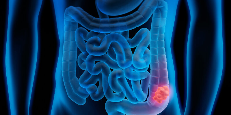 Həkim kolorektal xərçəngdən əlil qalmaq riski ilə bağlı xəbərdarlıq edib