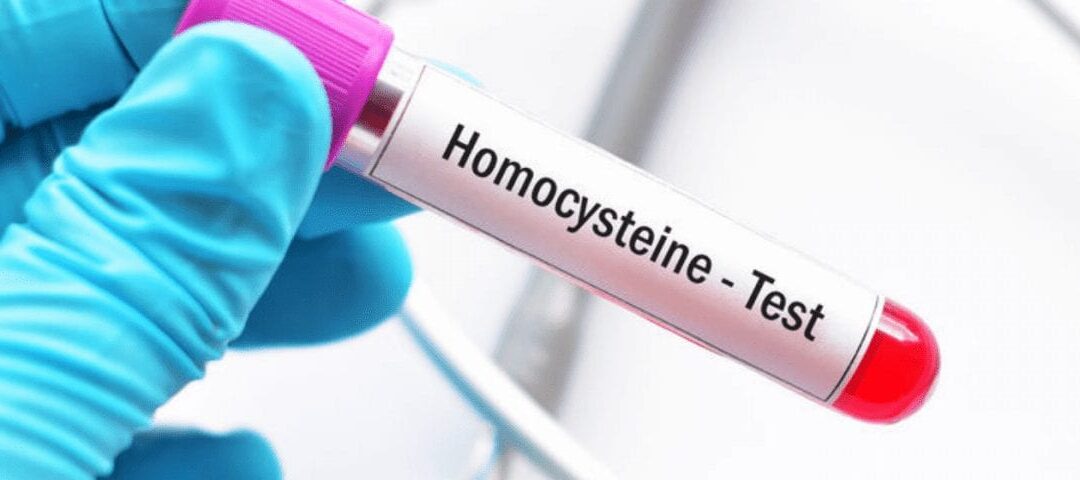 Homosistein analizi verərkən nələrə diqqət etməli?
