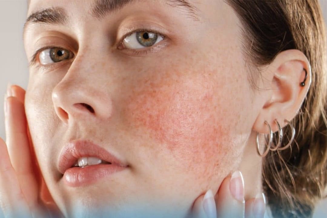 Qızılgül xəstəliyi nədir?