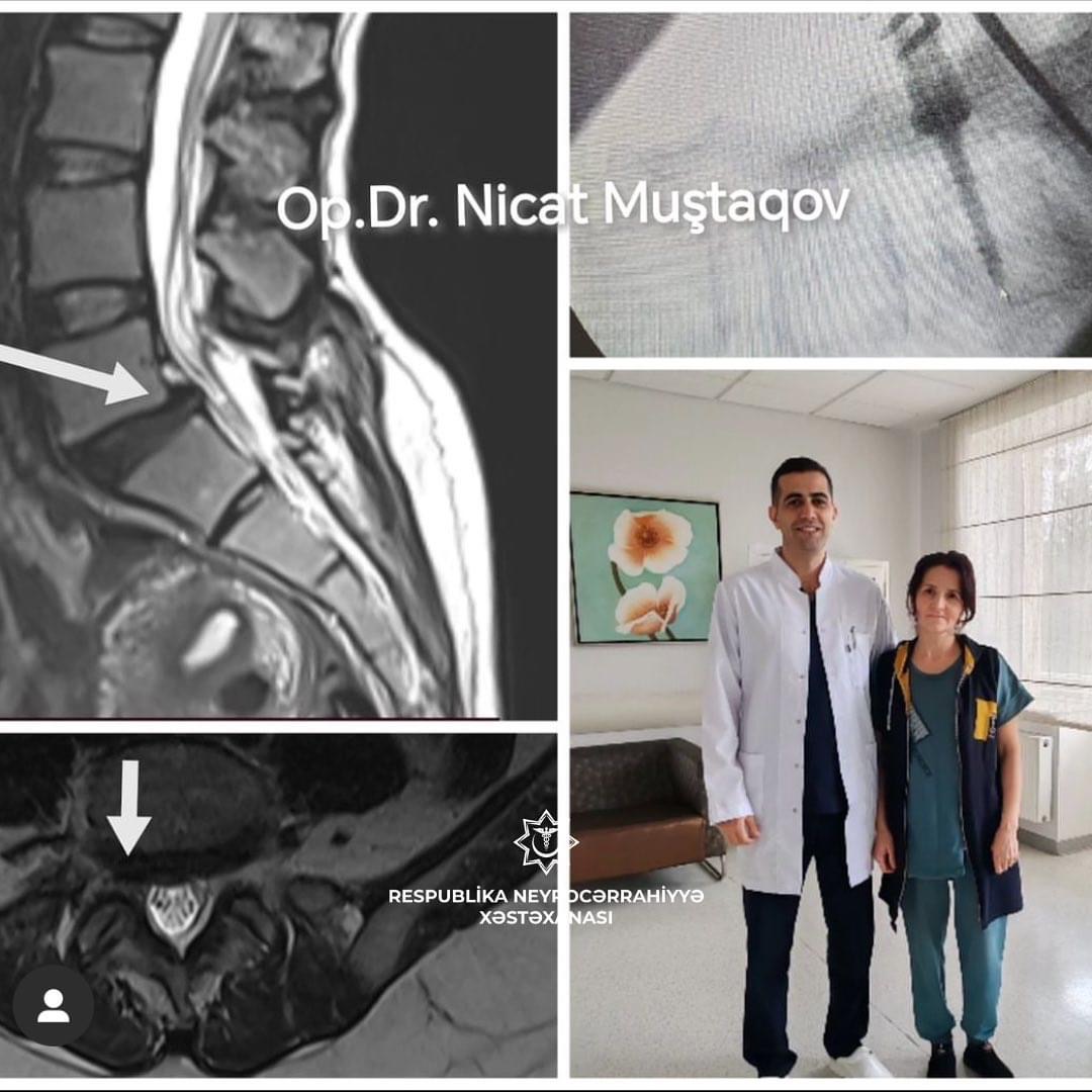 Kəskin bel və ayaq ağrıları olan xəstə Respublika Neyrocərrahiyyə Xəstəxanasında cərrahi əməliyyat olunub