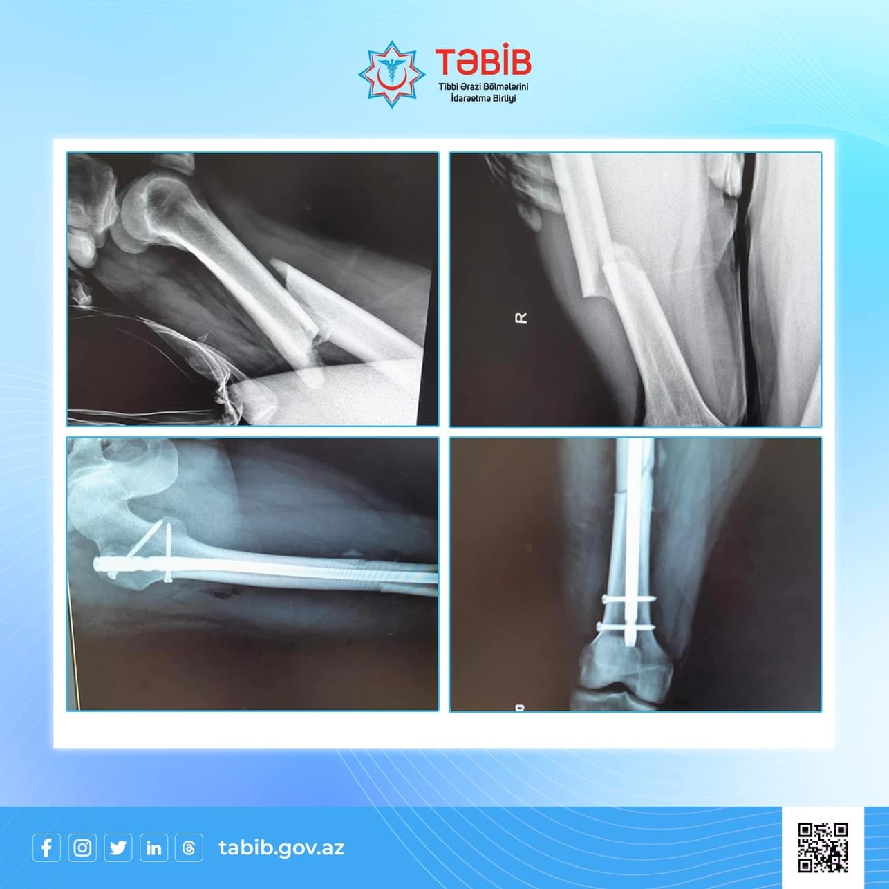Cənub regionunda ilk dəfə olaraq qapalı travmatoloji əməliyyat həyata keçirilib