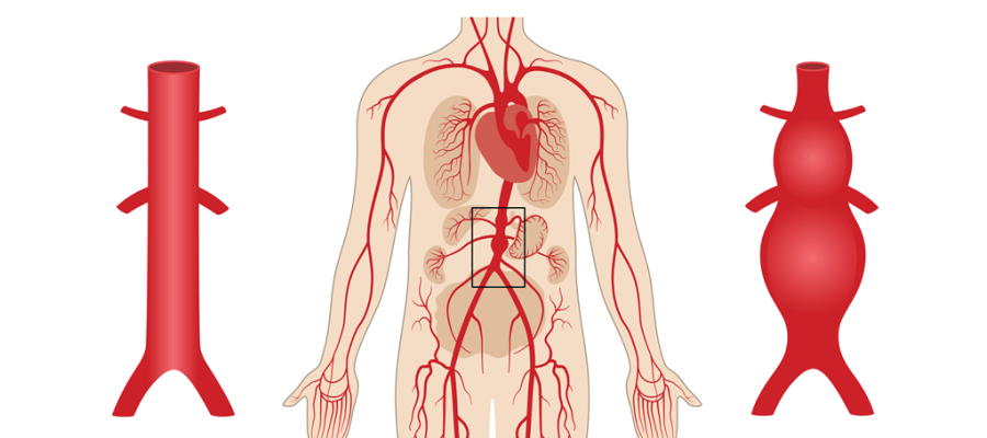 Abdominal aorta anevrizması və əlamətləri