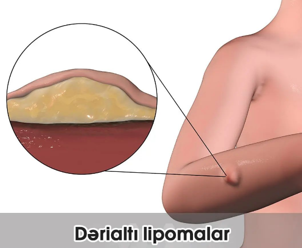 Dərialtı lipoma nədir? Diaqnozu və müalicəsi