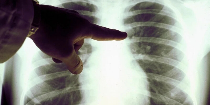 Ağciyər xərçəngində sağ qalmağı proqnozlaşdırmaq üçün yeni üsul məlum olub