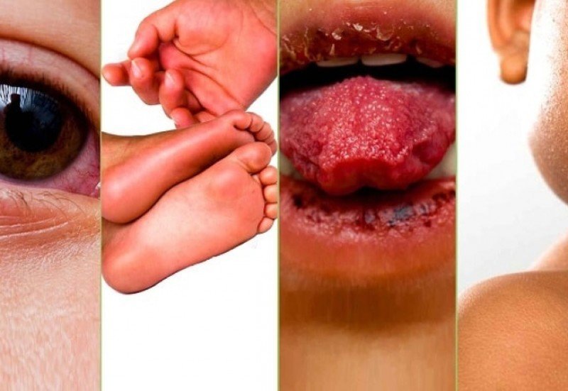 Yaponiyada Kavasaki xəstəliyinin yayılması kəskin şəkildə azalıb