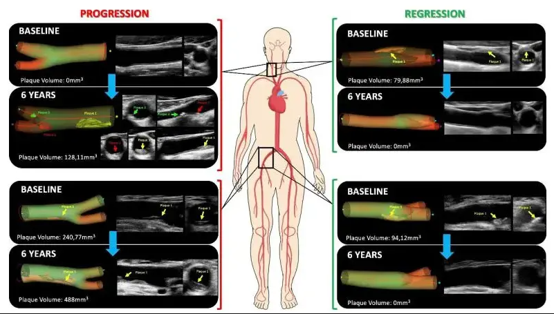 İnqilabi tədqiqat aterosklerozun bərpasını göstərir - Ürək xəstəliklərinin idarə edilməsində yeni dövr