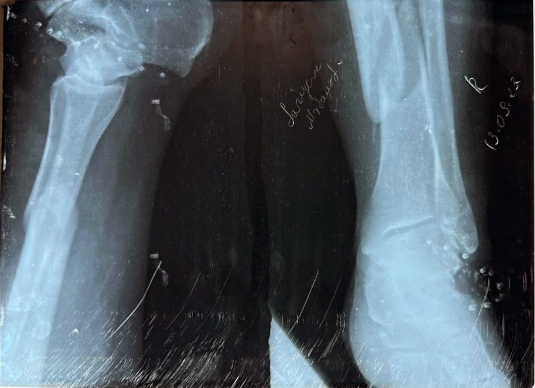 Şirvanda ilk dəfə olaraq bloklayıcı qapalı intramedulyar ştift qamış sümüyünün osteosintezi travmatoloji əməliyyatı icra olunub