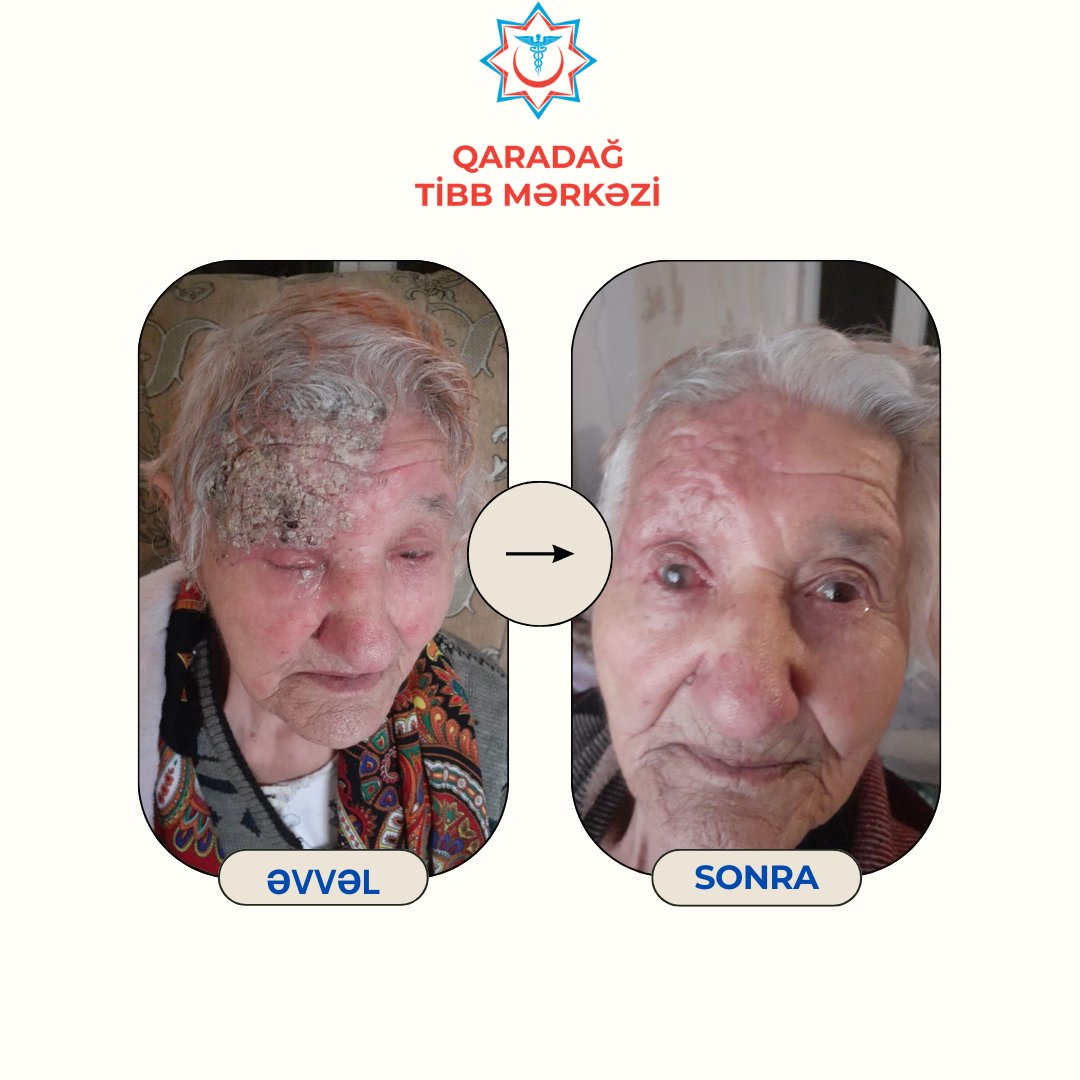 Kəmərləyici dəmrov diaqnozu qoyulan xəstə düzgün müalicədən sonra sağlamlığına qovuşub - Qaradağ Tibb Mərkəzi