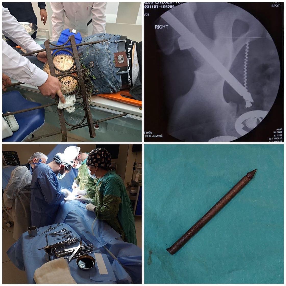 Hasardan tullanarkən ciddi xəsarət alan vətəndaş Abşeron Rayon Mərkəzi Xəstəxanasında uğurla əməliyyat olunub