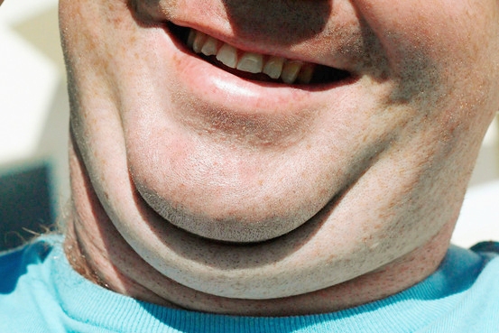 Mütəxəssis ikiqat çənənin görünməsinin ən təhlükəli səbəblərini sadaladı