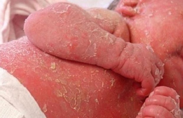 Ən çox yeni doğulmuş uşaqlarda rast gəlinən Leyner xəstəliyi