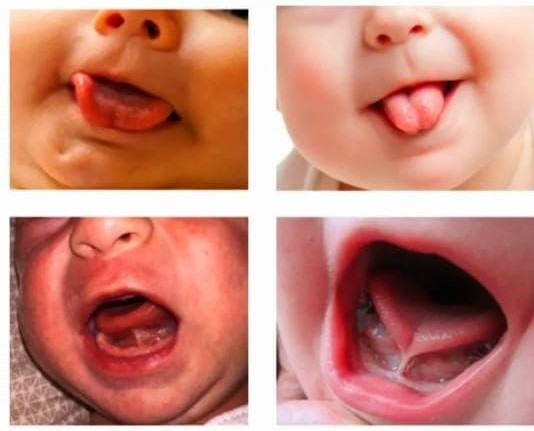 Uşaqlarda dilbağı nədir?