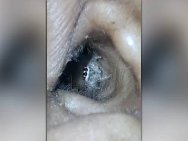 The Sun: Həkimlər qadının qulağında canlı hörümçək və yuvasını tapıblar