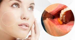 Bişektomiya əməliyyatı sonrası nə etmək lazımdır?