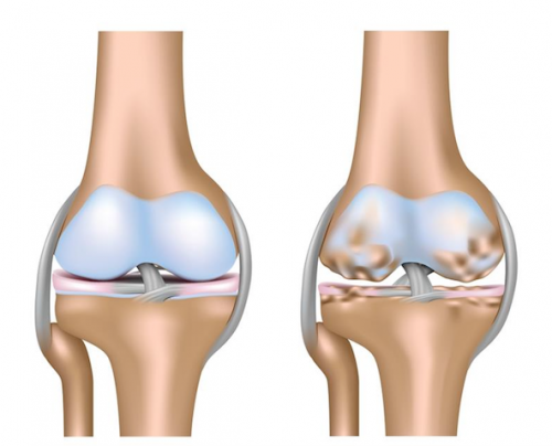 Duzlaşma ya osteoartroz - Fərq nədir?