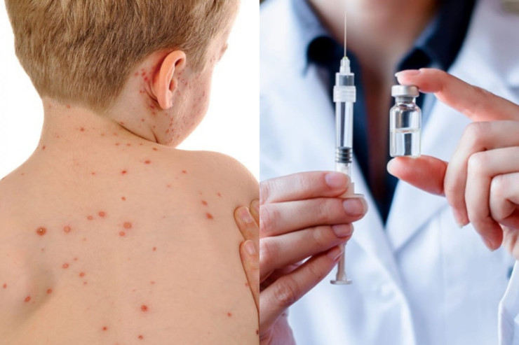 Səhiyyə Nazirliyi həssas əhali qruplarını qızılcaya qarşı peyvənd olunmağa çağırır