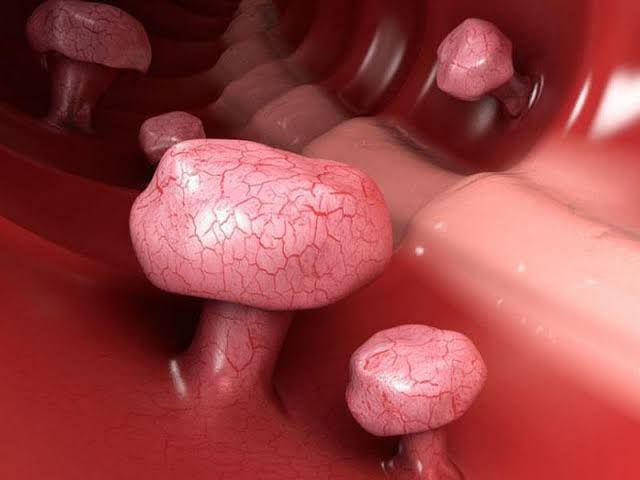 Polipin əmələ gəlməsinə səbəb olan amillər hansılardır?