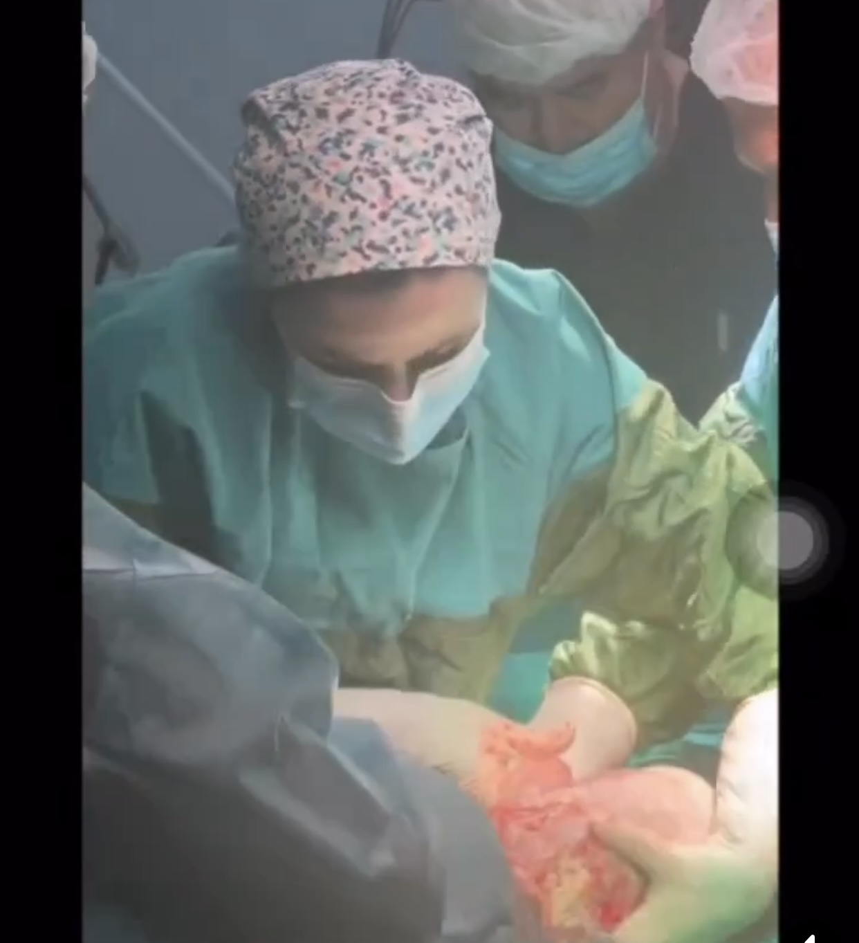 Zərdab Rayon Mərkəzi Xəstəxanasında son 20 ildə ilk dəfə qeysəriyyə əməliyyatı ilə körpə dünyaya gəlib