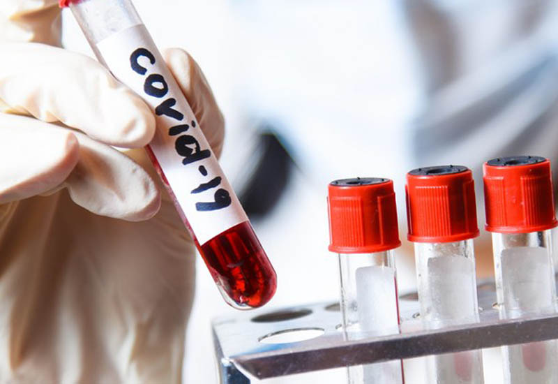 Ötən ay Azərbaycanda 325 nəfər koronavirusa yoluxub, onlardan 21-i ölüb
