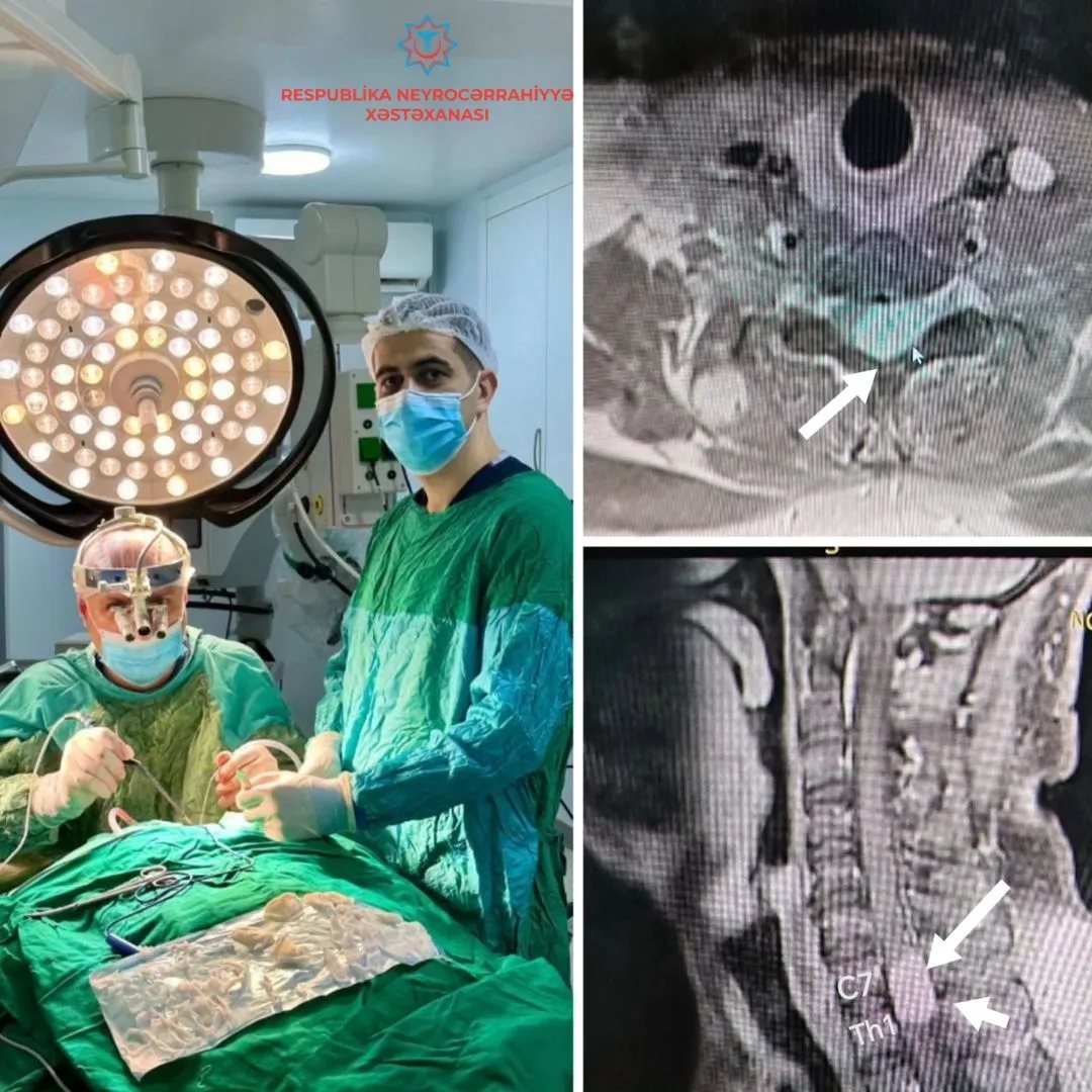 Respublika Neyrocərrahiyyə Xəstəxanasında daha bir uğurlu əməliyyat icra olunub
