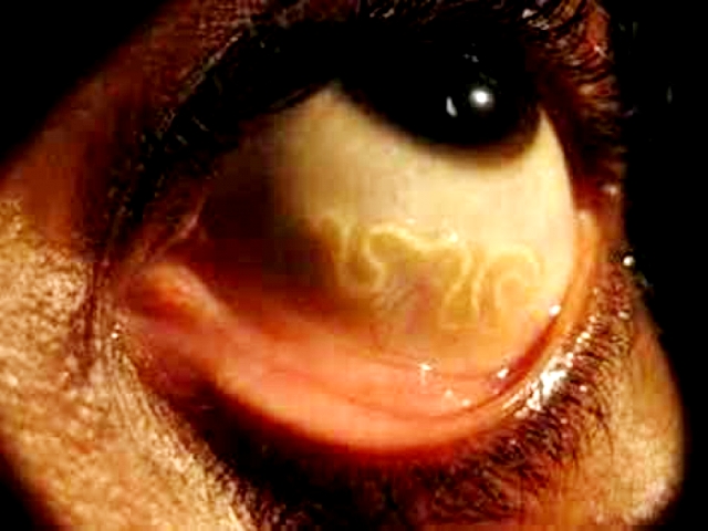Həkimlər qızın gözündən 12 santimetrlik parazit çıxarıblar