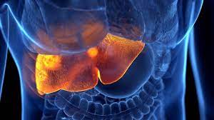 Qaraciyər yağlanmasının əsas səbəbləri və müalicə üsulları