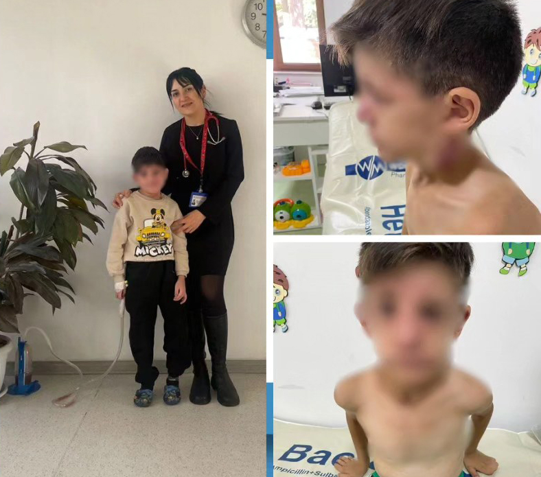 JOB sindromu diaqnozu qoyulan 8 yaşlı oğlan Respublika Uşaq Klinik Xəstəxanasında müalicə alıb