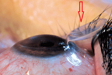 Nizami Tibb Mərkəzində göz əməliyyatları zamanı hidrofob və sensar intraokulyar linzalarından istifadə olunur
