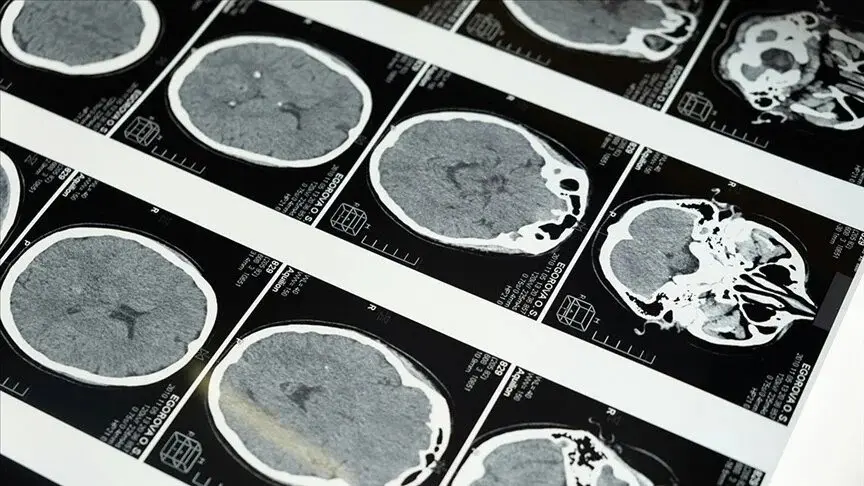 Dünyanın ən güclü MRT cihazı ilə çəkilmiş insan beyninin ən aydın görüntüsü dərc edilib