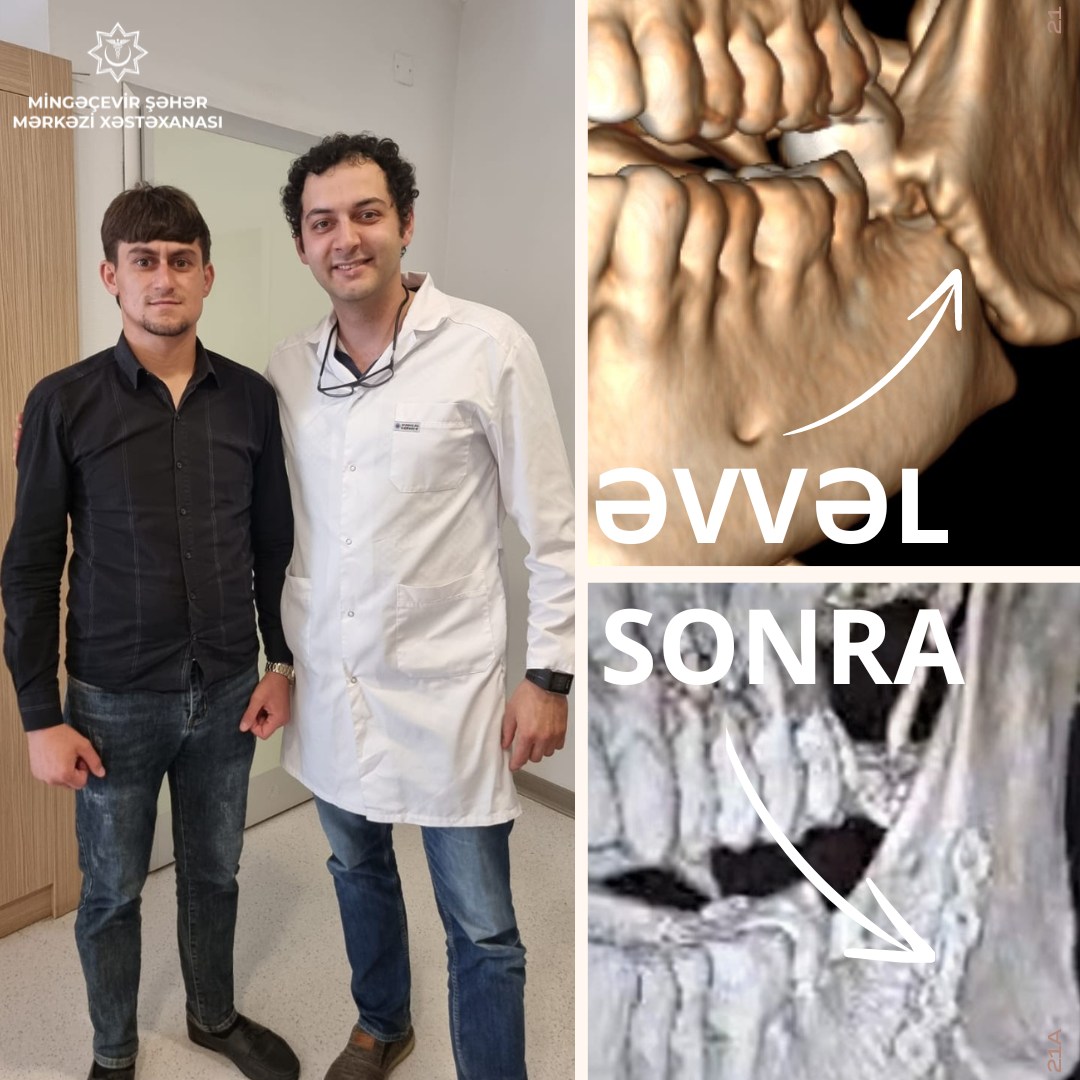 Mingəçevir ŞMX-da ilk dəfə olaraq aşağı çənənin yerdəyişməsi ilə sol bucaq sahəsinin sınığı əməliyyatı icra edilib