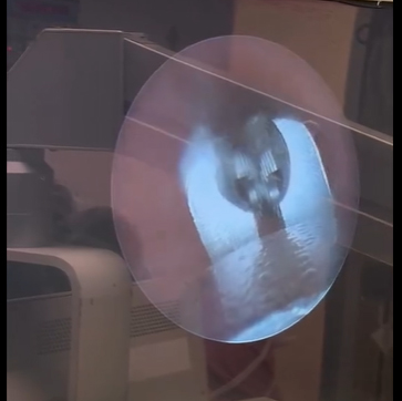 Sağ əsas bronxuna ləpə düşmüş 1 yaşlı uşaq Mərkəzi Klinikada əməliyyat olunub