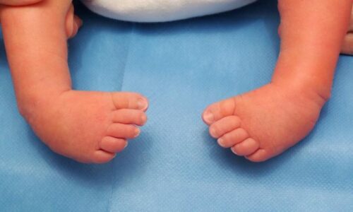 Diz əyriliyi osteoartroz və ya qonartrozun inkişafına gətirib çıxara bilər